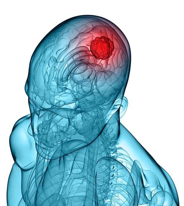 Beyin Metastaz Tedavisi Gamma Knife